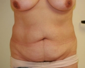 Feel Beautiful - Mommy Makeover San Diego Case 3 - Before Photo